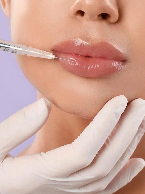 Injecting filler into fuller lips